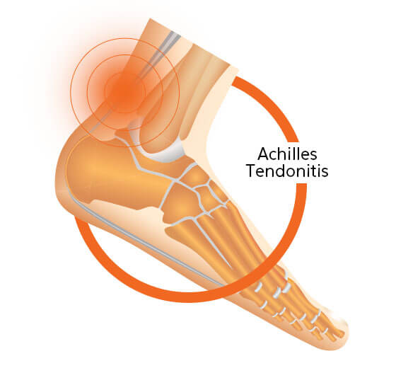 Achilles Tendonitis Diagram Image