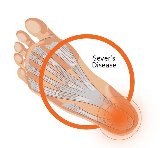 Sever's Disease Diagram Image